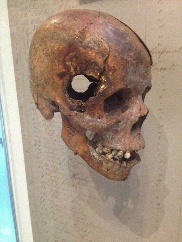 A Civil War Skull With A Fatal Wound From An Exploding 12-Pound Artillery Shell