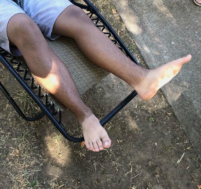 Piernas con ampollas y moretones en un padre descansando en silla de jardín, ilustrando un día peor que el tuyo.