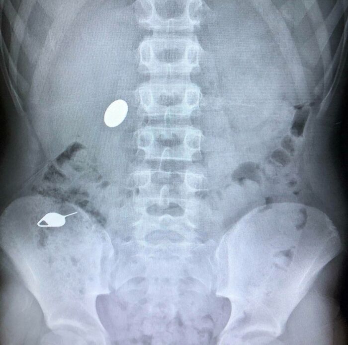 Radiografía abdominal mostrando objetos extraños ingeridos, ilustrando situaciones de padres y madres teniendo un día peor que el tuyo.