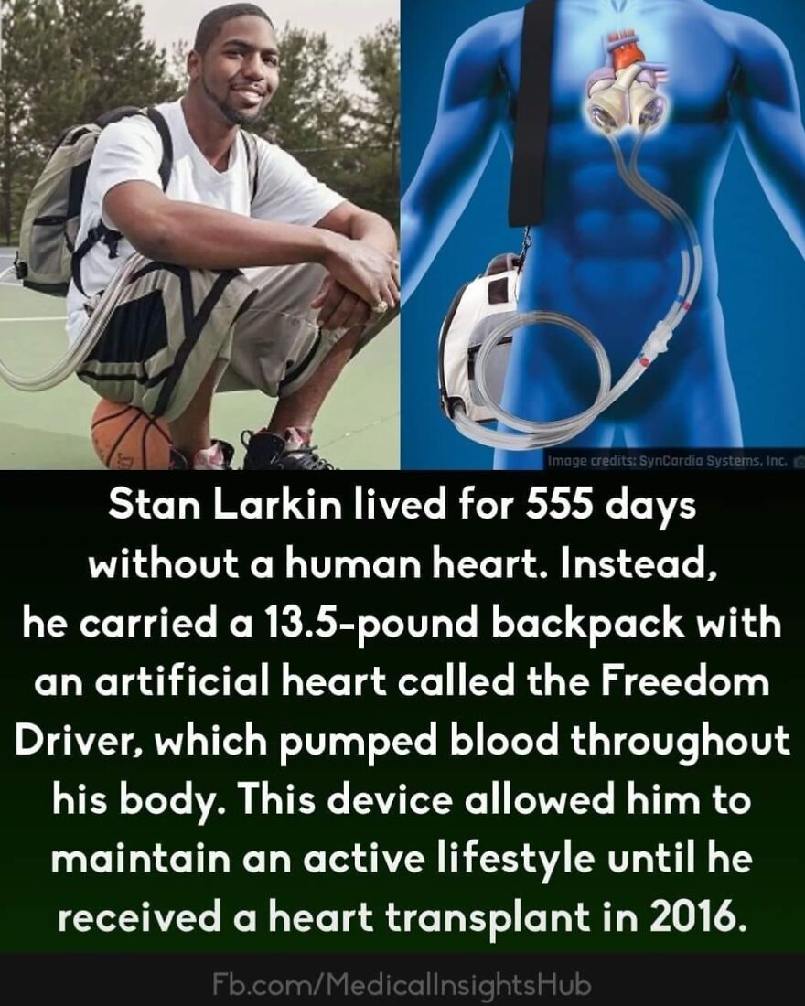 Man sitting on a basketball with an artificial heart device backpack pumps blood, reflecting curious medical facts about muscles.