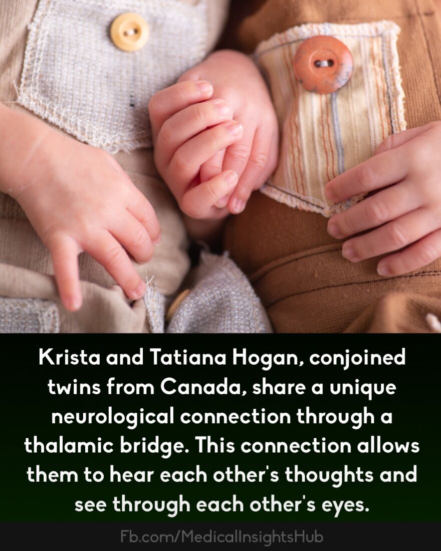 Close-up of conjoined twins’ hands illustrating unique neurological connection linked to fingers that contain no muscles.
