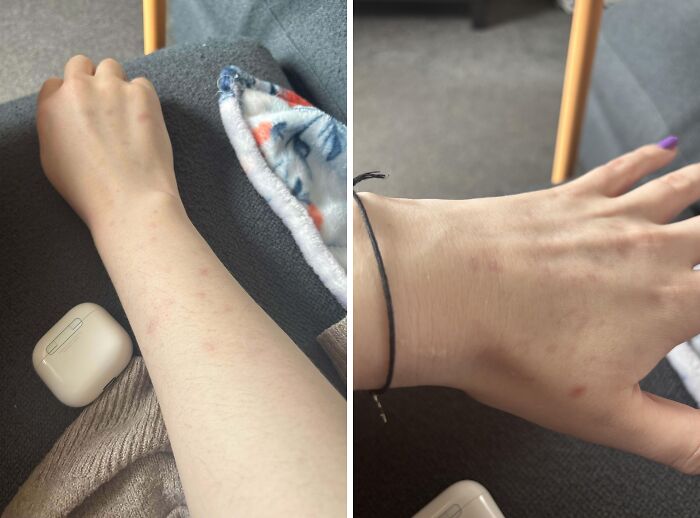 Arms with red marks and scratches, likely caused by infuriating public transport passengers' careless behavior.