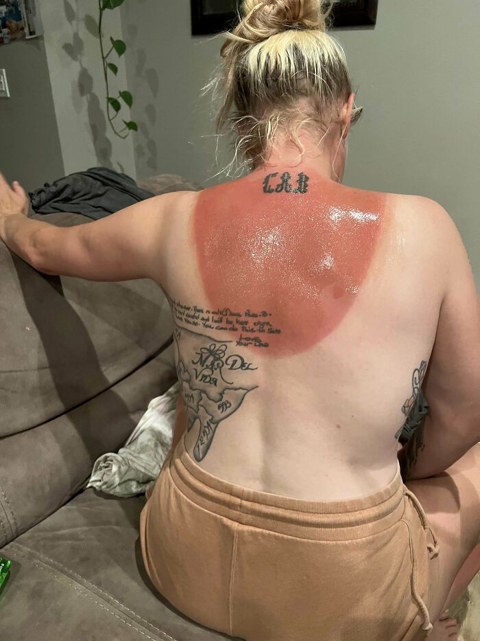 Woman with severe sunburn on her upper back sitting on a couch showing skin trauma and pain from sun exposure.