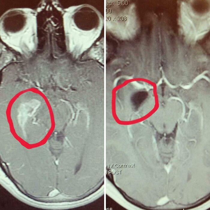 Side-by-side comparison MRI scans highlighting differences in brain areas, illustrating variety in medical imaging.