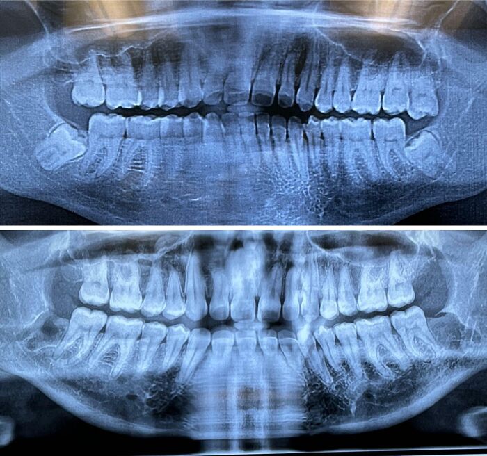 Comparison image of two dental X-rays highlighting variety in tooth alignment and jaw structure.