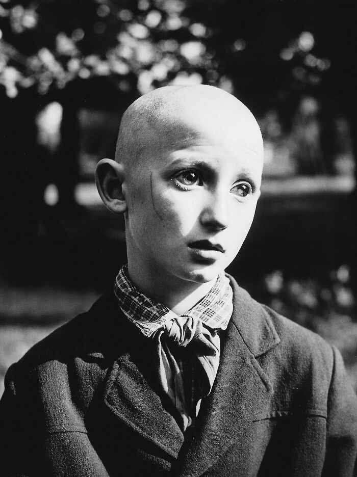 Black and white photo of a bald child with a scar, wearing a suit and tie, in a creepy and unsettling vintage setting.