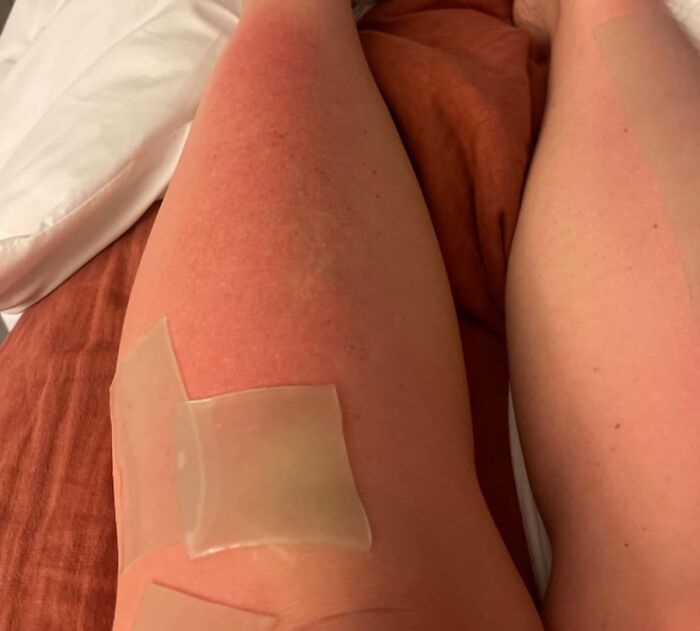 Sunburned leg with cooling gel patches resting on a bed, illustrating summer annoyances and ways to fight back.