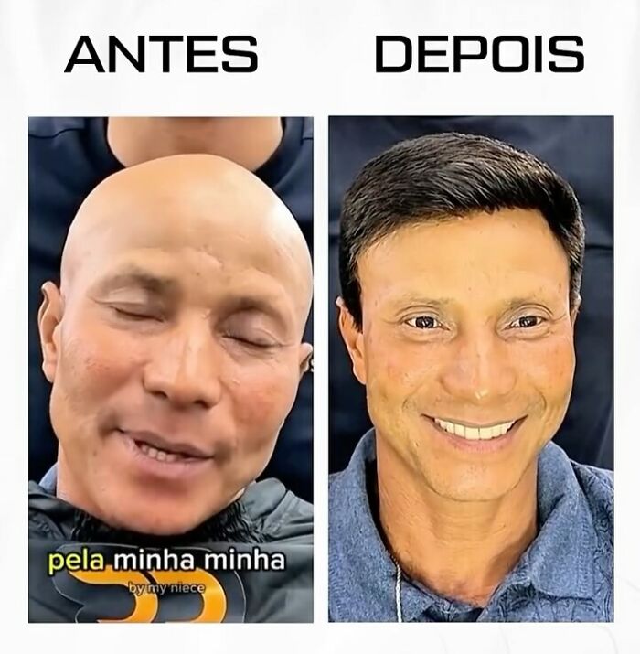 Before and after transformation of a man with baldness by a Brazilian stylist, showing natural-looking hair restoration results.