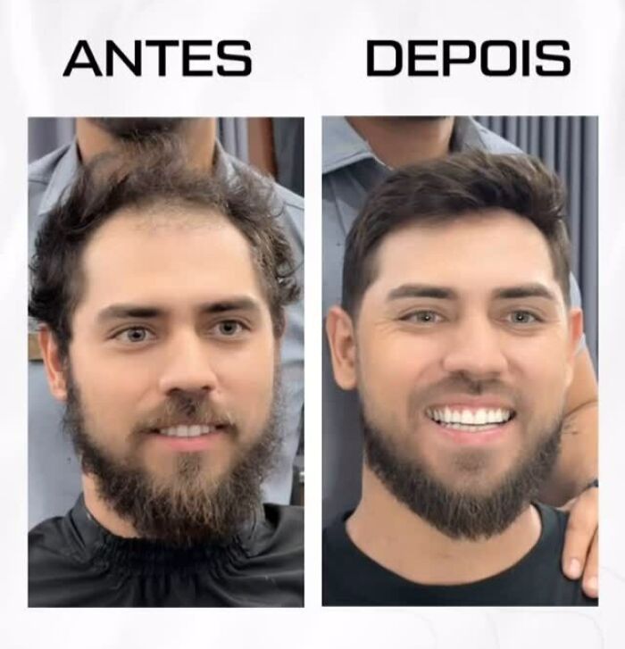 Before and after images showing Brazilian stylist's work helping men with baldness regain a natural hair look.