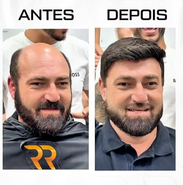 Man with baldness transformed by Brazilian stylist, showing before and after results with restored natural-looking hair.