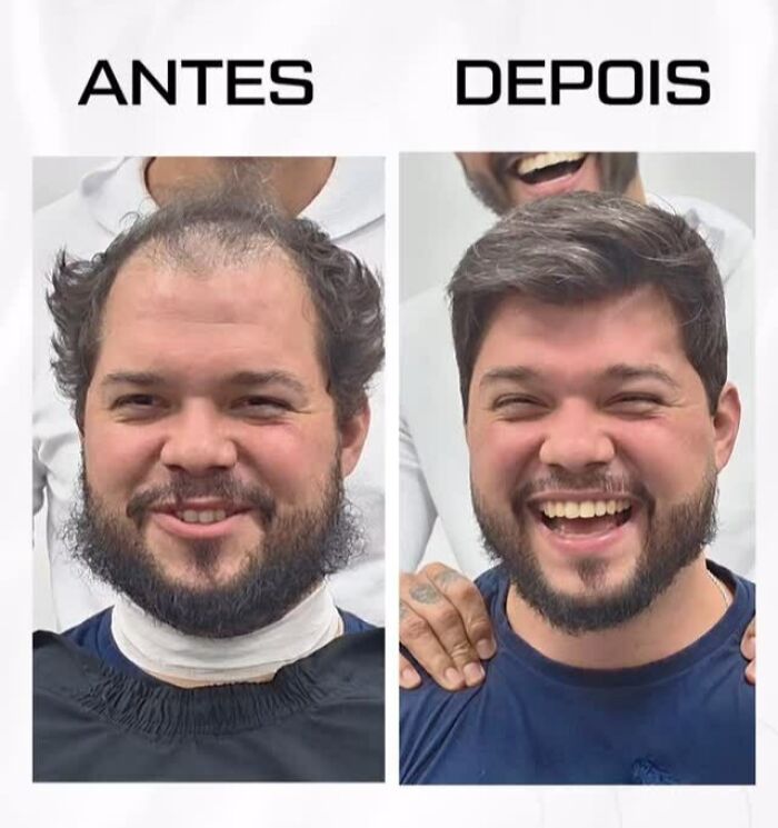 Before and after photos showing a Brazilian stylist helping men with baldness restore their natural look and confidence.