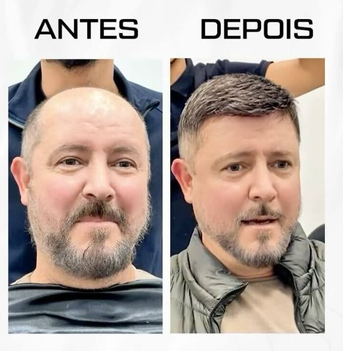Before and after photos showing Brazilian stylist's hair transformation for men with baldness, restoring natural appearance.