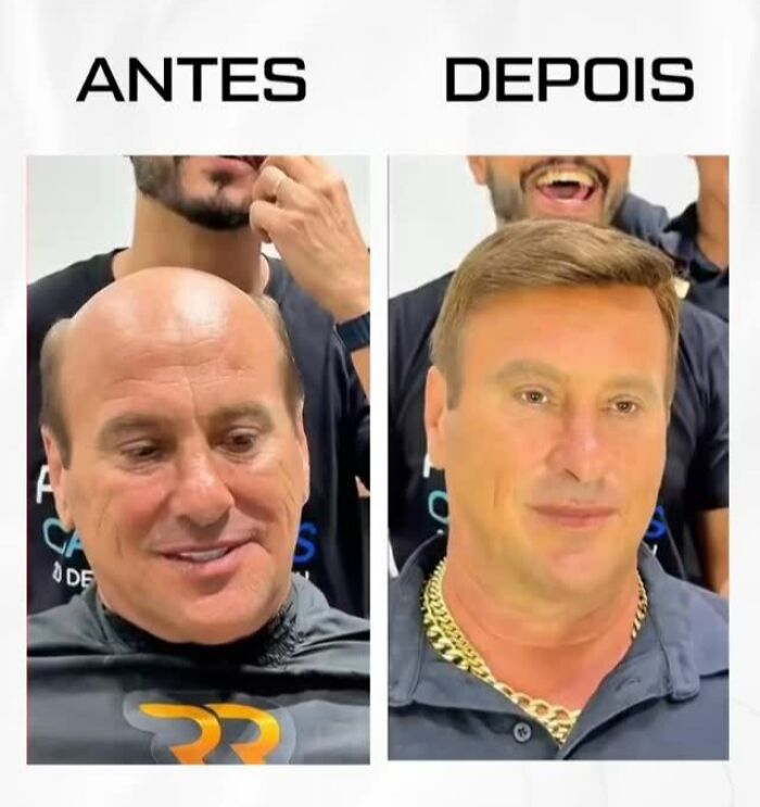 Before and after images showing a Brazilian stylist helping a man with baldness regain a natural look.