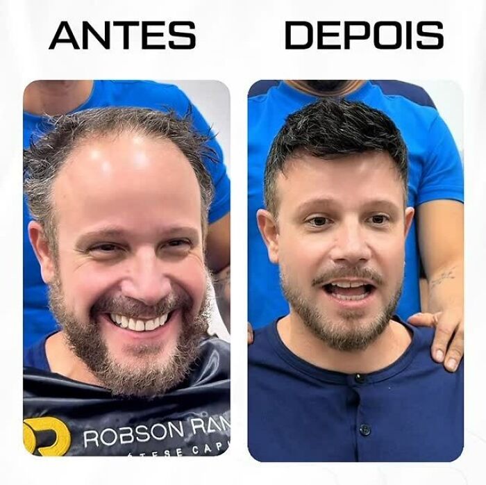 Before and after images showing Brazilian stylist's work helping men with baldness restore their natural look.