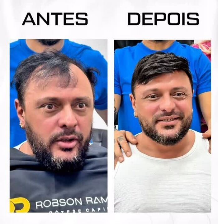 Man before and after hair transformation by Brazilian stylist, showcasing impressive results for men with baldness.