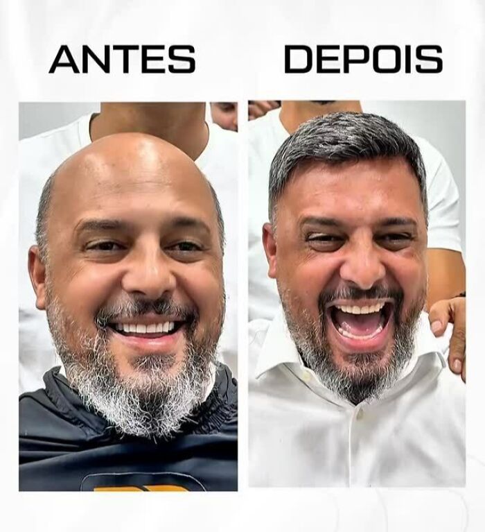 Man with baldness before and after Brazilian stylist's hair restoration, smiling and looking confident in side-by-side photos.