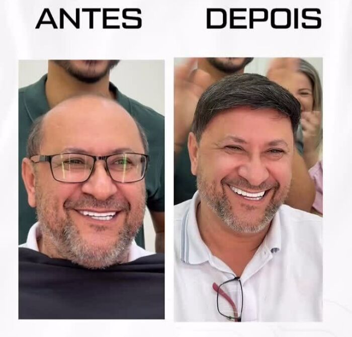 Before and after images showing a Brazilian stylist's hair restoration results for men with baldness, boosting confidence.