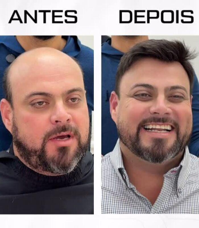 Before and after transformation of a man with baldness, styled by Brazilian stylist helping men look like themselves again.