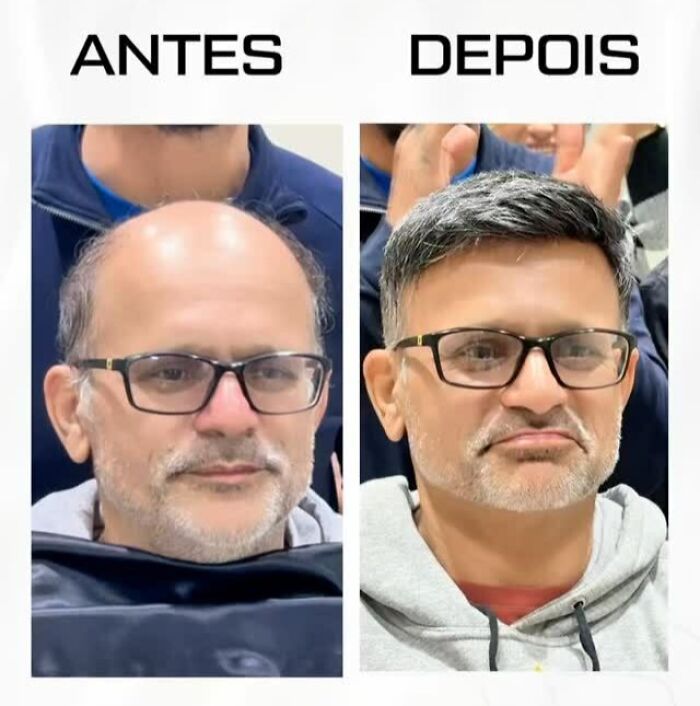 Man with glasses showing before and after photos of Brazilian stylist's work helping men with baldness look natural.
