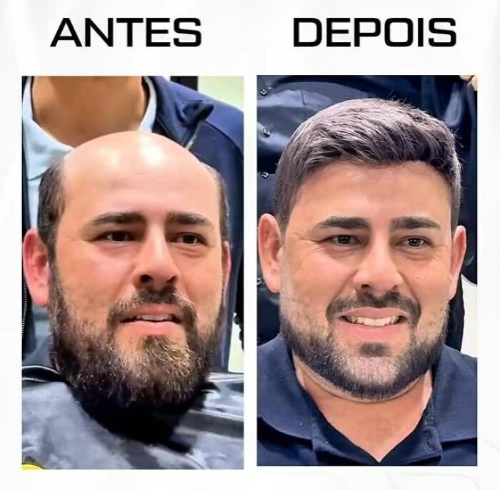 Before and after photos of a man showing impressive results by Brazilian stylist helping men with baldness look natural again.