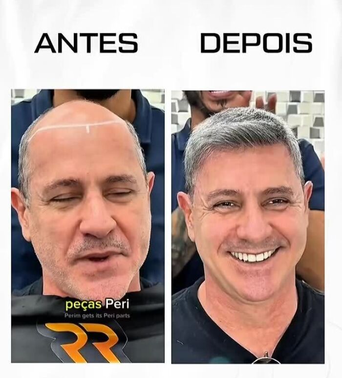 Man with baldness before and after hairstyling by Brazilian stylist, showing impressive hair restoration results.