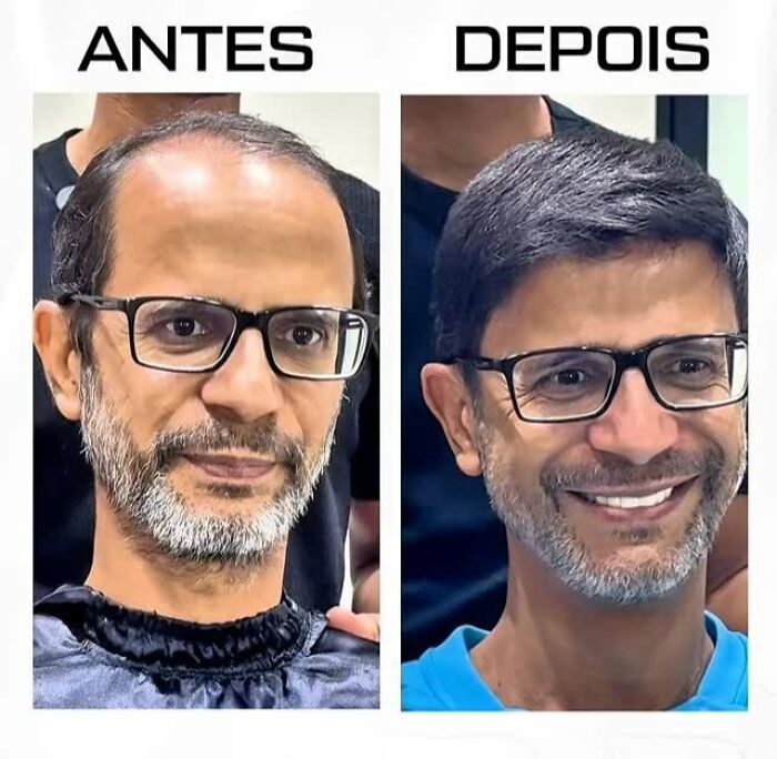 Man with baldness before and after transformation by Brazilian stylist, showing restored hair and natural look with glasses.