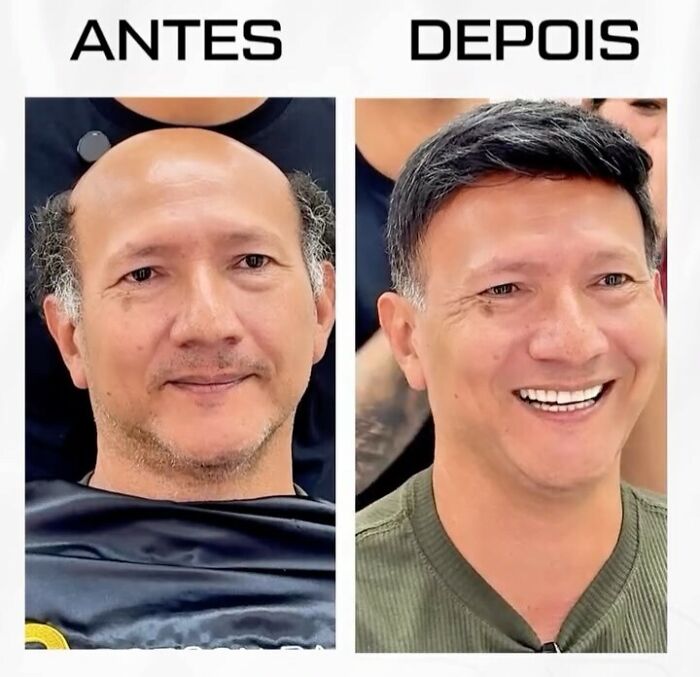 Before and after images of a man showing impressive results from Brazilian stylist helping men with baldness.