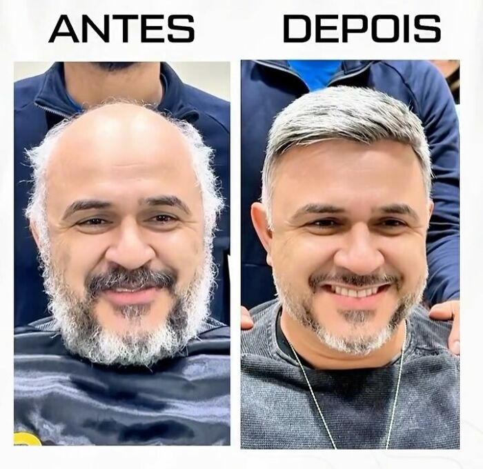 Before and after photos of a man with baldness transformed by a Brazilian stylist to restore his natural look.