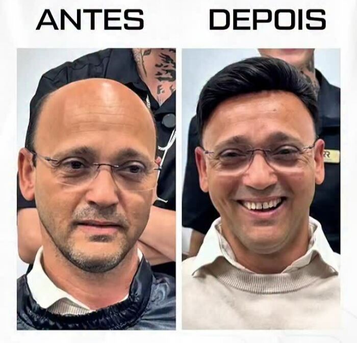 Before and after photos of a man treated by a Brazilian stylist helping men with baldness regain their natural look.