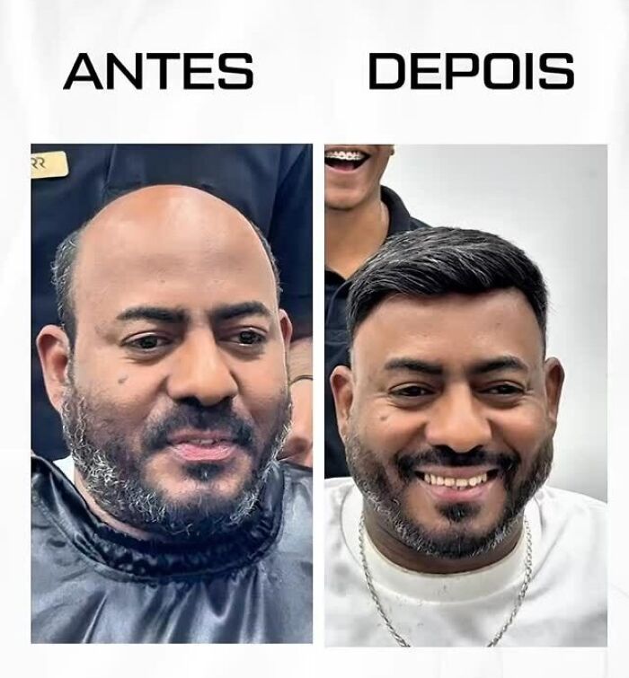 Before and after images showing a Brazilian stylist helping men with baldness restore their natural look and confidence.