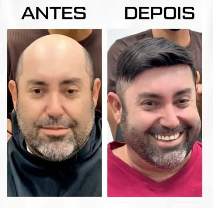 Man shows impressive hair transformation by Brazilian stylist helping men with baldness look like themselves again.