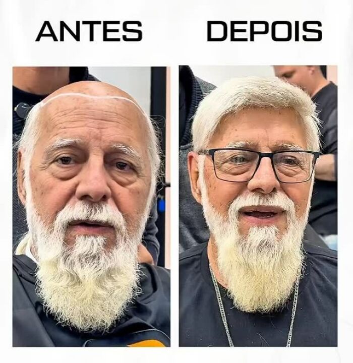 Before and after transformation of a man with baldness, styled by a Brazilian stylist helping men look like themselves again.