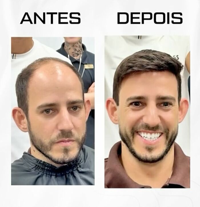 Before and after photos showing a Brazilian stylist helping a man with baldness look like himself again with restored hair.