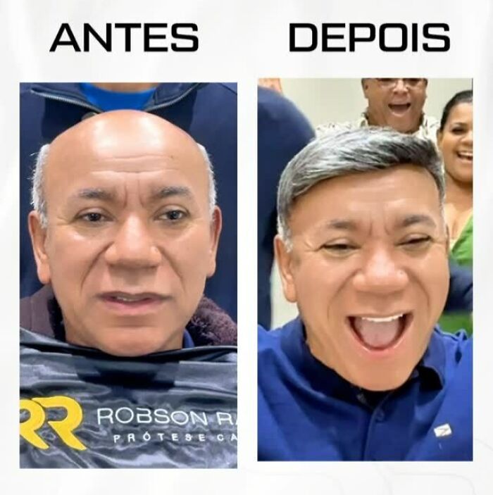 Before and after photos showing a Brazilian stylist helping a man with baldness regain his natural look.