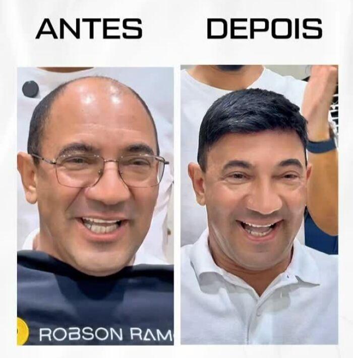 Before and after photos of a man with baldness showing hair restoration by Brazilian stylist, highlighting impressive transformation results.