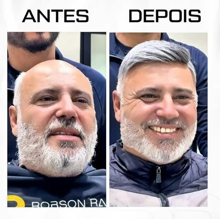 Before and after photos showing a Brazilian stylist helping men with baldness regain their natural look.