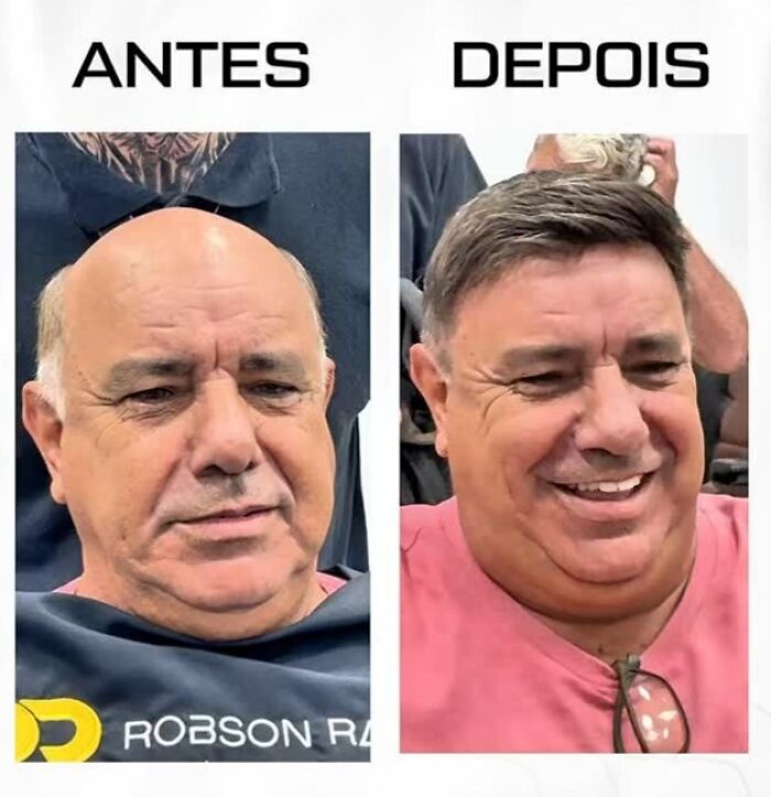 Before and after photos showing a Brazilian stylist helping a man with baldness look like himself again with hair restoration.