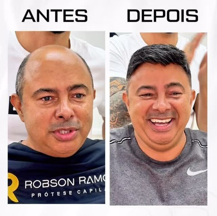 Before and after photos of a Brazilian stylist helping a man with baldness regain his natural look and confidence.