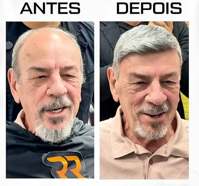 Before and after images of a man with baldness transformed by a Brazilian stylist to restore his natural look.