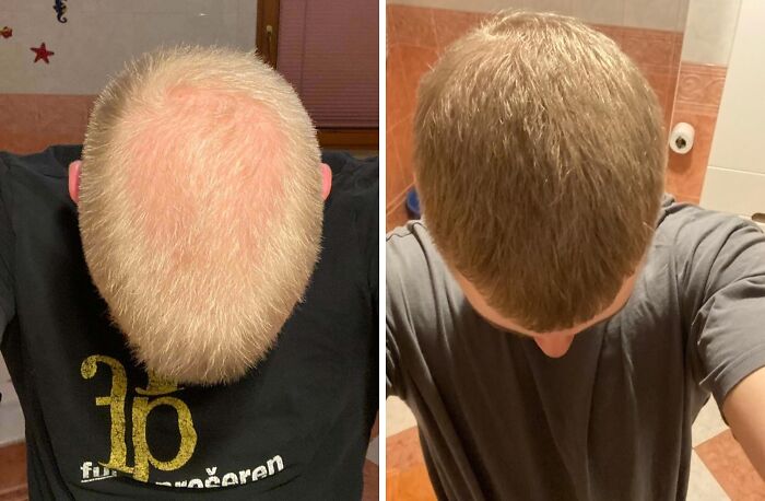 Before and after photo showing significant hair growth transformation in a heartwarming online shared image.