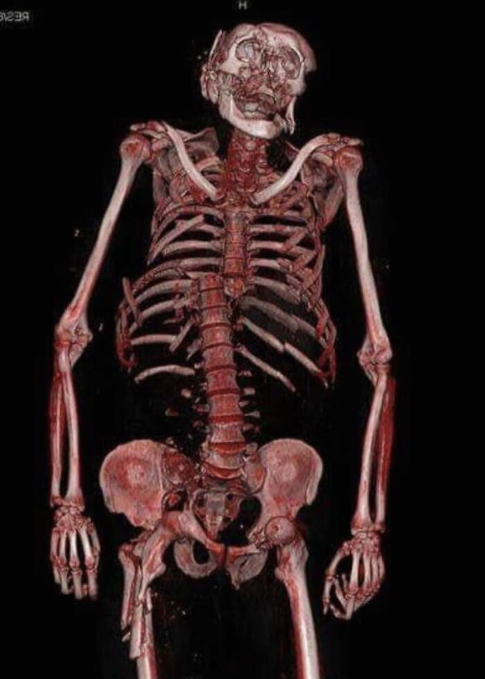 3D medical scan showing a detailed human skeleton with bones and soft tissue in a gory medical case illustration.