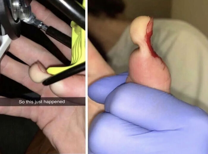 Close-up of a medical case showing a large blister on a finger being treated with medical tools and gloves.