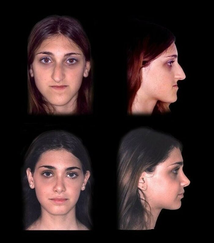 Before and after medical case photos showing facial reconstruction results in a gory and interesting medical case.