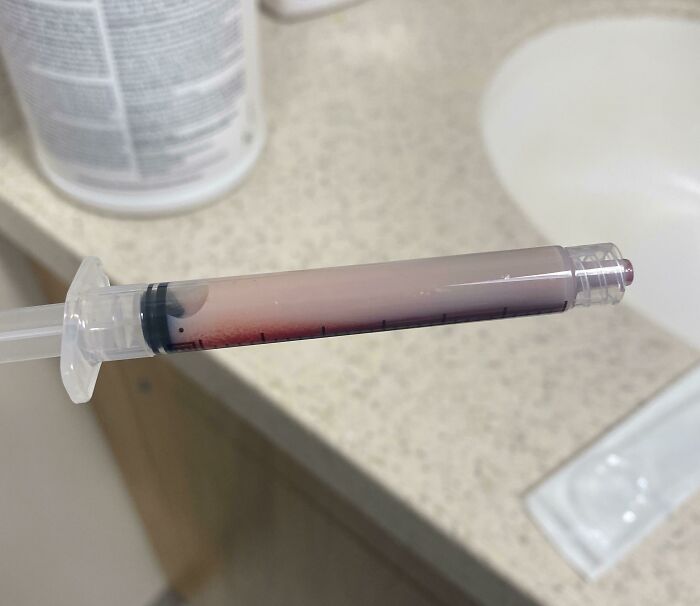 Syringe filled with blood and fluid, showcasing a medical case that is both gory and interesting in a clinical setting.