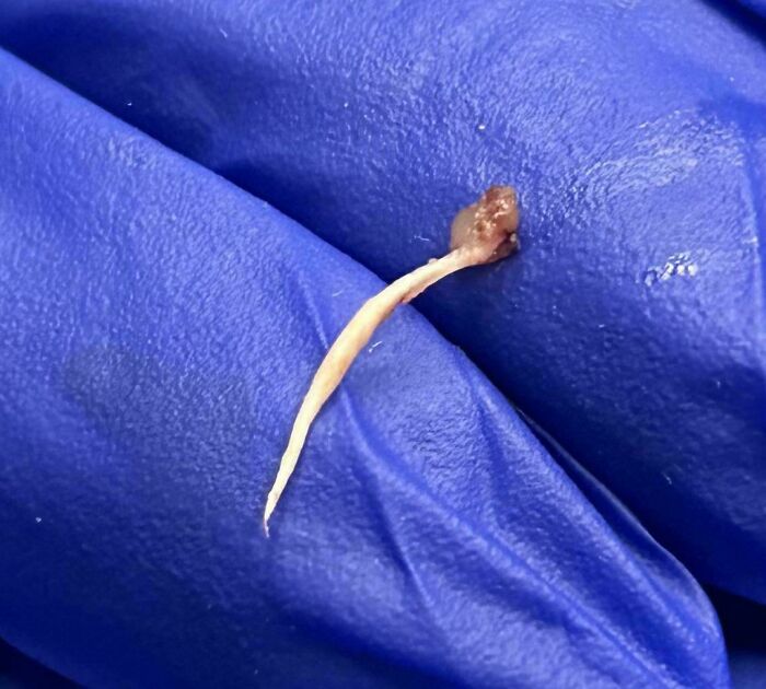 Close-up of a gloved hand holding a small extracted item in medical cases known for being gory and interesting.