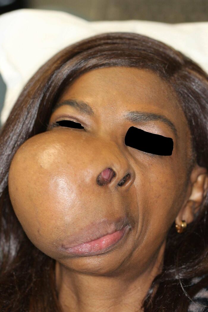 Close-up of woman with large facial tumor showing a gory and interesting medical case of severe facial swelling.