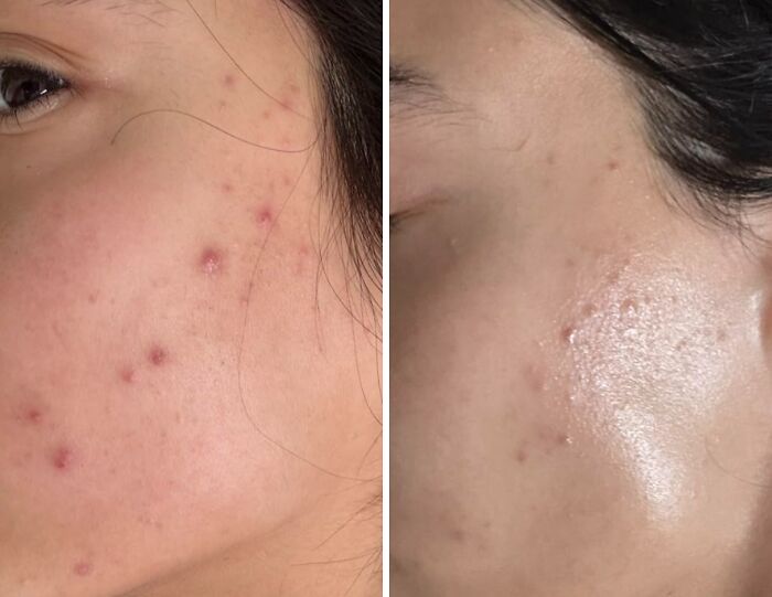 Before and after close-up of cheek skin showing acne and improved complexion, illustrating genius ways to fix little glitches.
