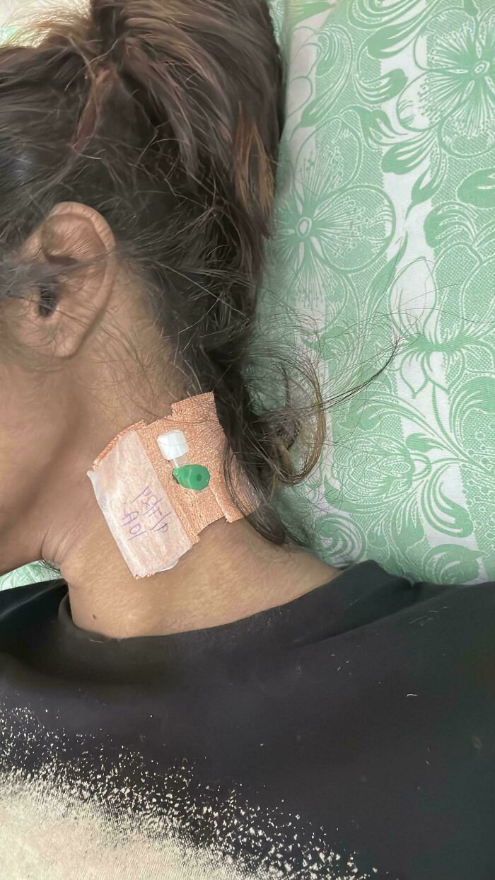 Close-up of a medical case showing a neck IV catheter taped to skin, illustrating gory and interesting medical cases.