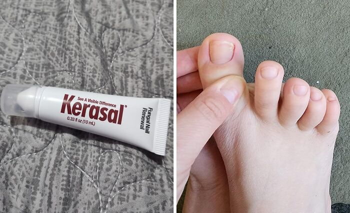 Tube of Kerasal antifungal nail treatment next to a close-up of a person's toes, illustrating fixing little glitches.