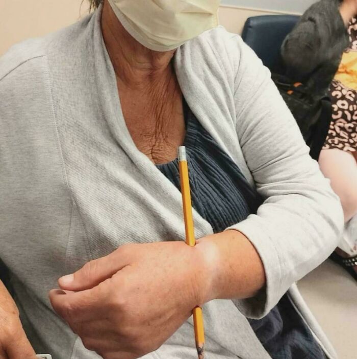 Elderly woman with swollen arm impaled by pencil, depicting a gory and interesting medical case in a clinical setting.